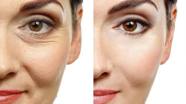 botox treatment in reno before and after